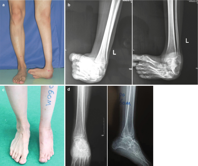 Tibia Duality