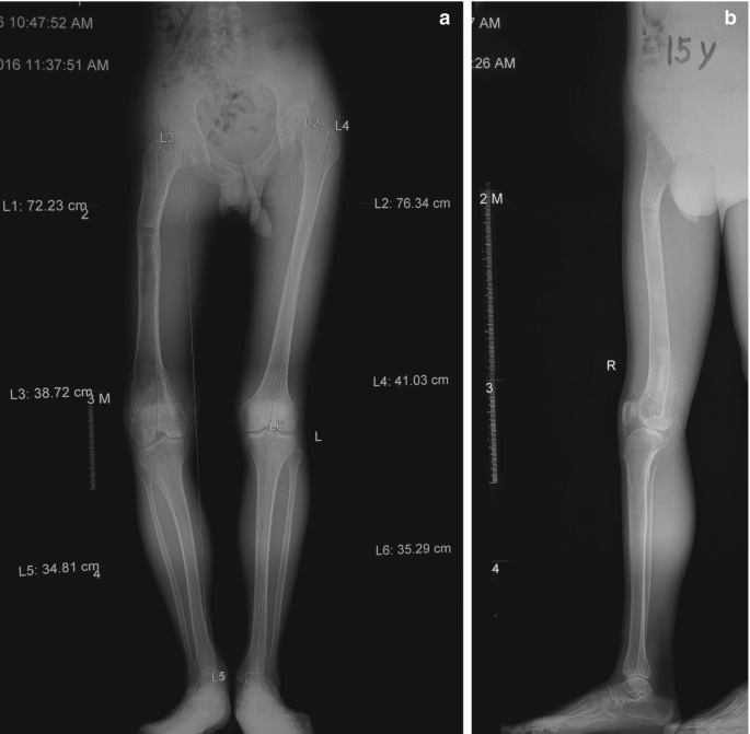 Lower Limb Deformity Caused by Tumor and Tumor-Like Disease