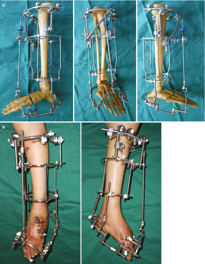 Orthopedic Fracture Ring Frame External Fixation System Ring Fixator -  China Tibia Trauma Fixator, Illizarov External Fixation