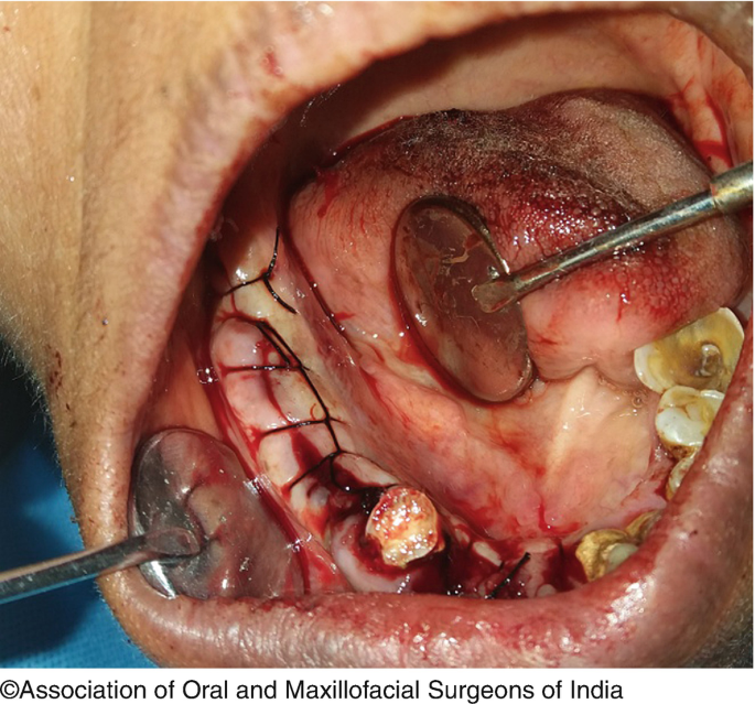 Wound Closure and Care in Oral and Maxillofacial Surgery | SpringerLink