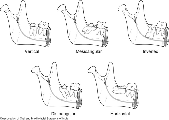 inverted impacted wisdom tooth