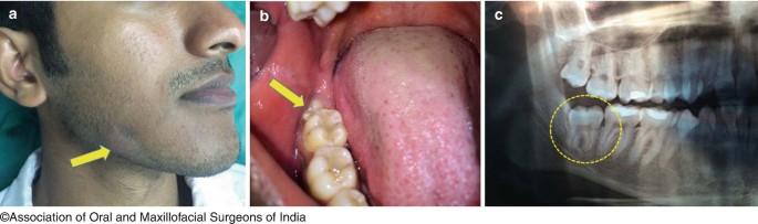 The treatment of impacted mandibular second molars using brass