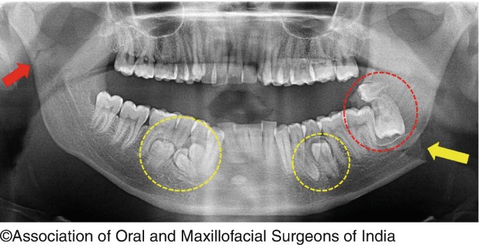 Management of Impacted Third Molars | SpringerLink