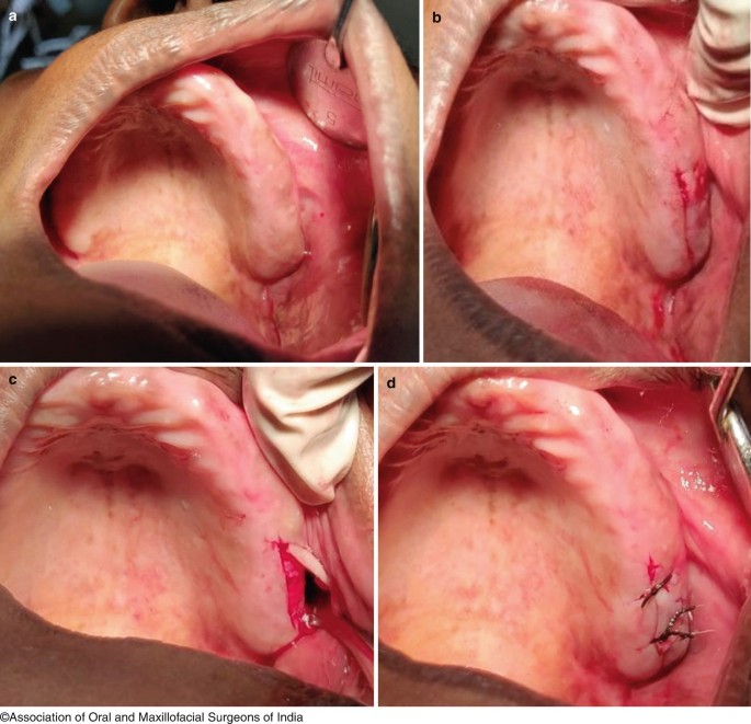 genial tubercle reduction
