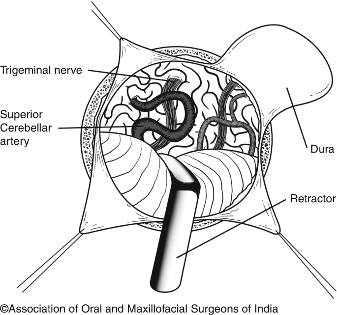 Trigeminal Neuralgia Springerlink