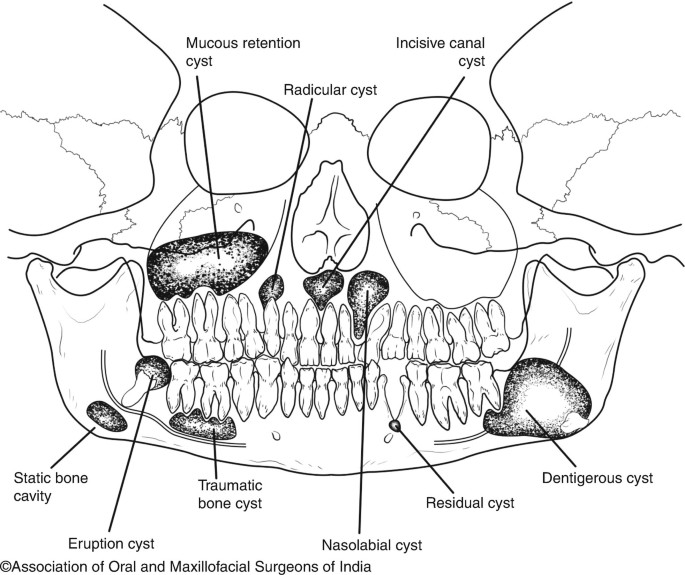 Cysts of the “Oro-Maxillofacial Region” | SpringerLink