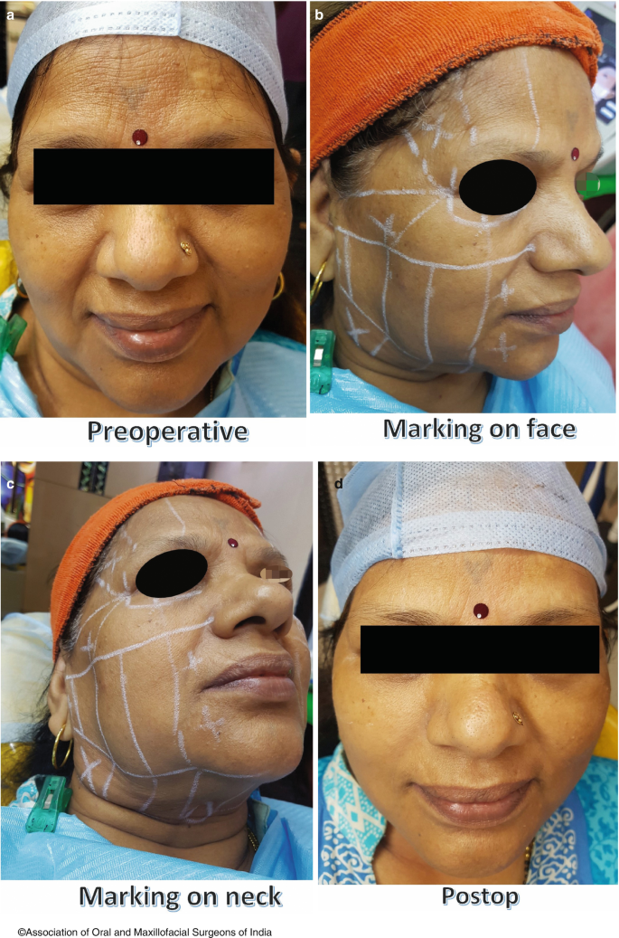 Non-surgical Modalities of Facial Rejuvenation and Aesthetics
