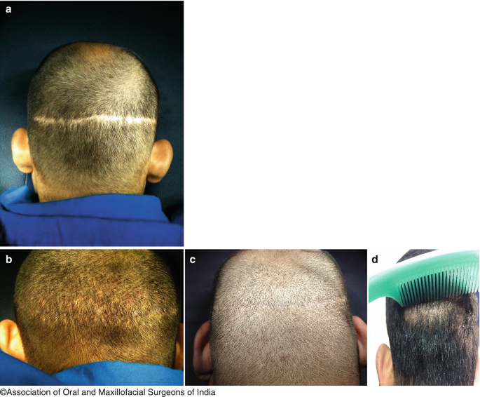 Hair Transplantation | SpringerLink Hair Transplantation | SpringerLink