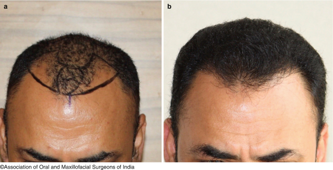 Hair Transplantation | SpringerLink Hair Transplantation | SpringerLink