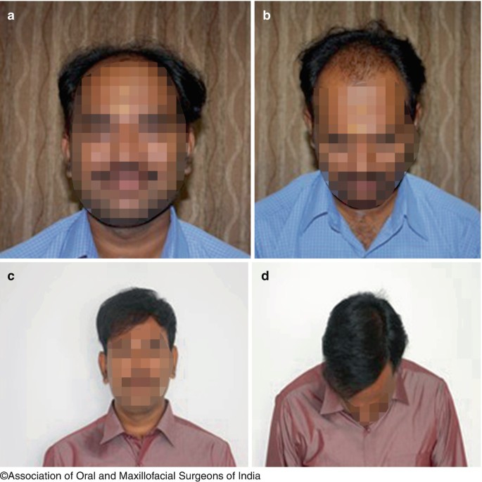 Hair Transplantation | SpringerLink Hair Transplantation | SpringerLink