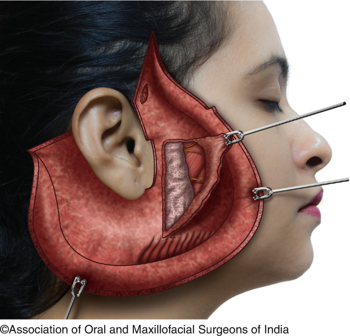 Ear & Earlobe Surgery  Visage Facial Plastic Surgery