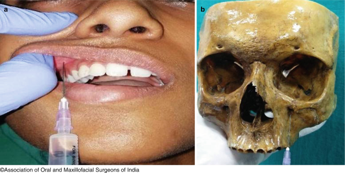 maxillary nerve block high tuberosity approach