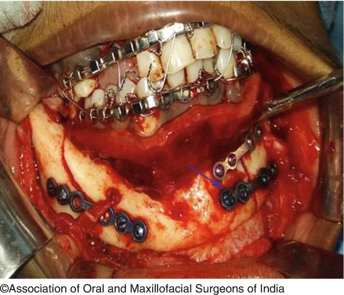 Treatment of horizontal impaction of left mandibu - 굿스마일포럼