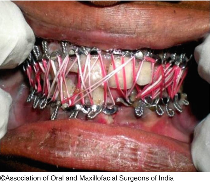 Fractures of the Mandible | SpringerLink