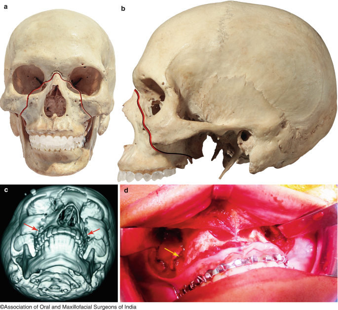 Maxillary Fractures | SpringerLink