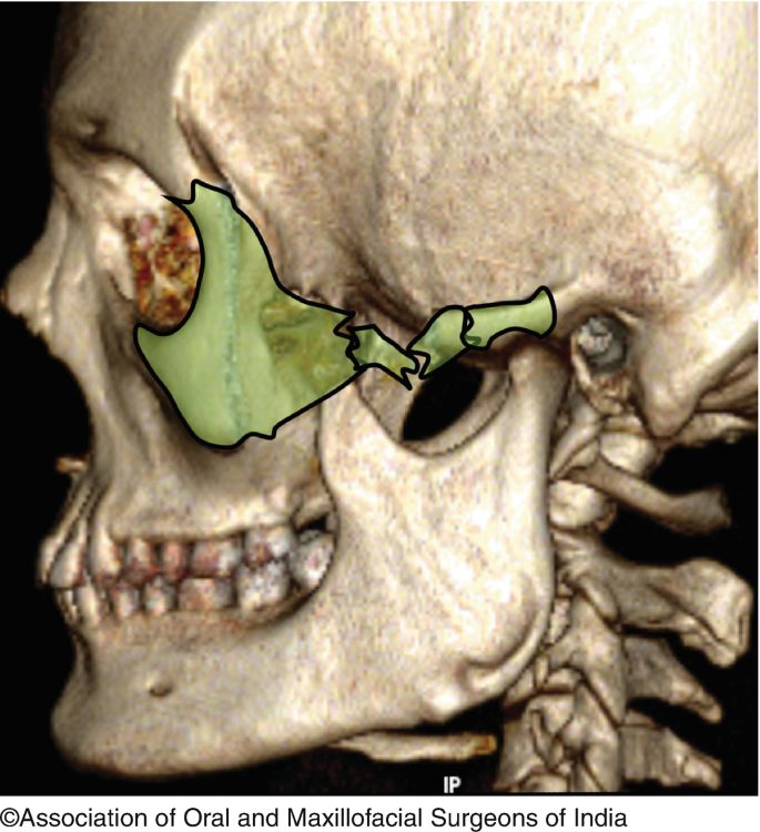 treatment fracture of zygomatic