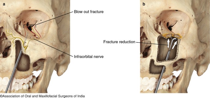 Orbital Fractures Springerlink