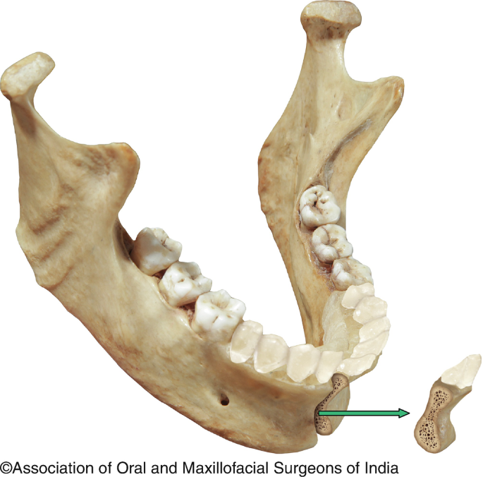 Diagrammatic representation of the normal anatomy of the mandibular