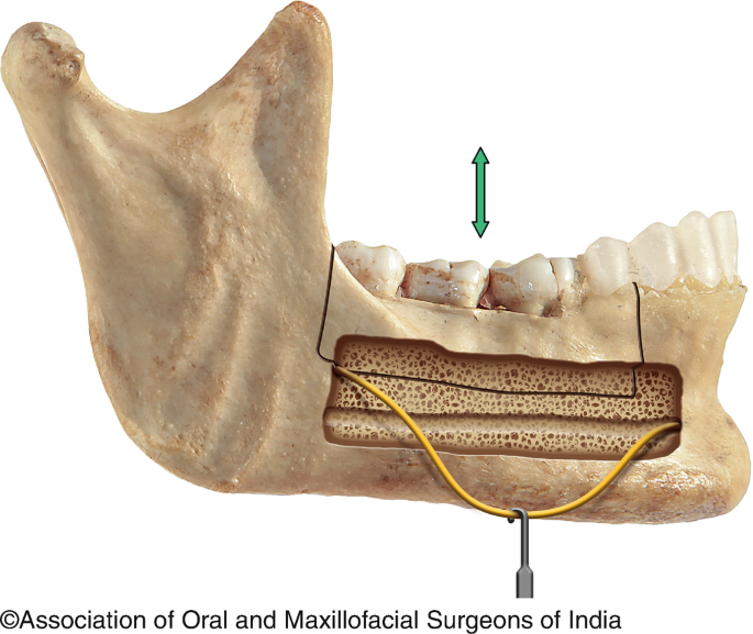 Diagrammatic representation of the normal anatomy of the mandibular