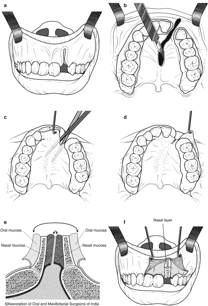 Alveolar Bone Grafting | SpringerLink