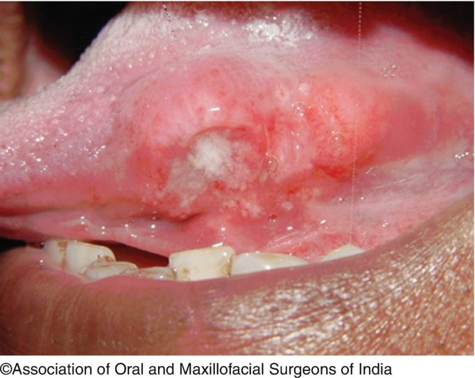 squamous cell carcinoma mouth