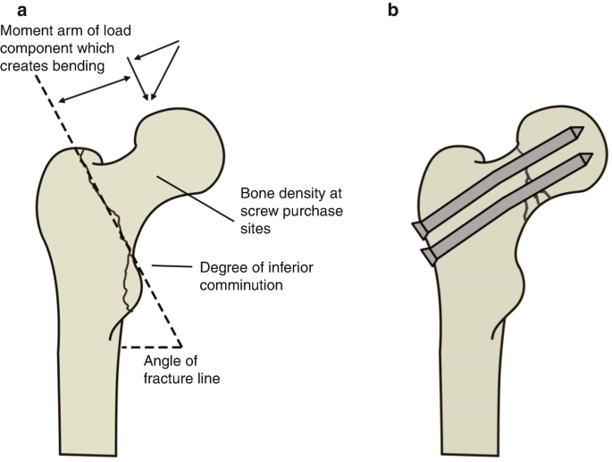 Two illustrations of a bone. In part A a dotted line in the fracture denotes the degree of inferior comminution and angle of the fracture line. In part B two screws are loaded in the femoral neck.