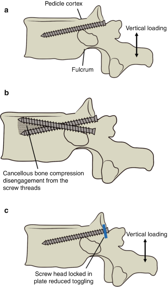 Three illustrations. In part A a screw is loaded between the pedicle cortex and the fulcrum. In part B two screws are loaded by intersecting each other below the pedicle. In part C a screw is loaded and toggled with a plate.