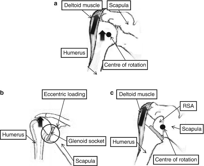 Figure a: 2 upward arrows in deltoid muscle and point of centre of rotaion. Figure b: eccentric loading is labeled in the glenoid socket with an upward arrow. Figure c: centre of rotation marked near R S A and scapula.