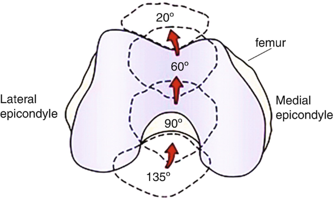 An illustration of patella bone with knee flexion marked from bottom to up as 135 degrees, 90 degrees, 60 degrees, and 20 degrees. The lateral and medial epicondyle are labeled at the sides.