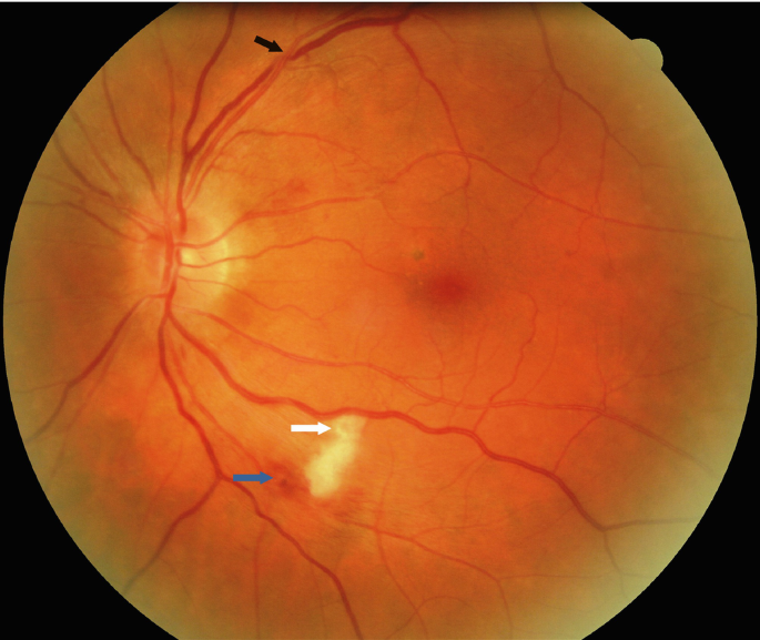 Normal Retina vs. Papilledema - Trial Exhibits Inc.