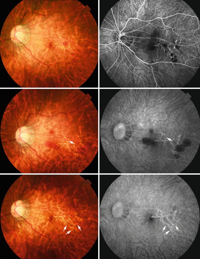 Lacquer Cracks, Simple Macular Hemorrhage and Myopic Stretch Lines |  SpringerLink