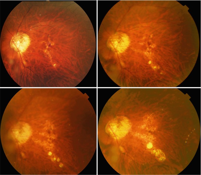 Lacquer Cracks, Simple Macular Hemorrhage and Myopic Stretch Lines |  SpringerLink