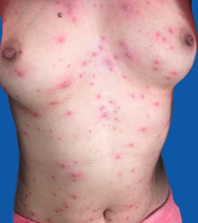 Viral Dermatoses in HIV/AIDS Patients | Homeopathic | Best Homeopathic Doctor in Pakistan | Dr Qaisar Ahmed MD, DHMS