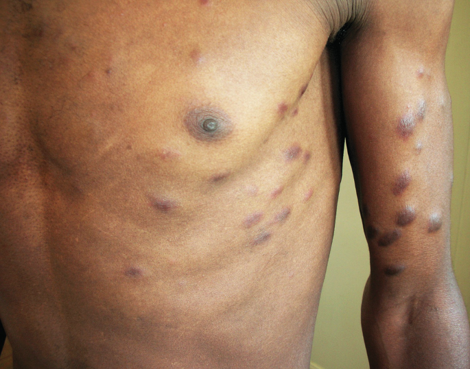 Neoplastic Diseases in HIV/AIDS Patients | SpringerLink