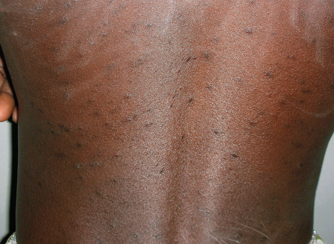 Inflammatory Dermatosis in HIV/AIDS Patients | SpringerLink