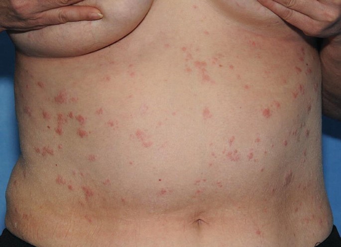 Sarcoidosis-Dr-Qaisar-Ahmed-Most-experienced-Homeopathic-doctor-Al-Haytham-clinic-KPK-Pakistan