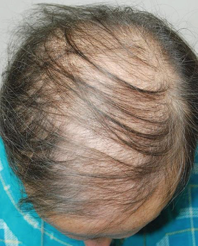 Disorders of Hair | SpringerLink Disorders of Hair | SpringerLink