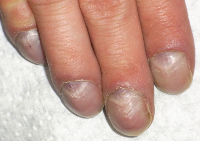 Disorders of Nails | SpringerLink Disorders of Nails | SpringerLink