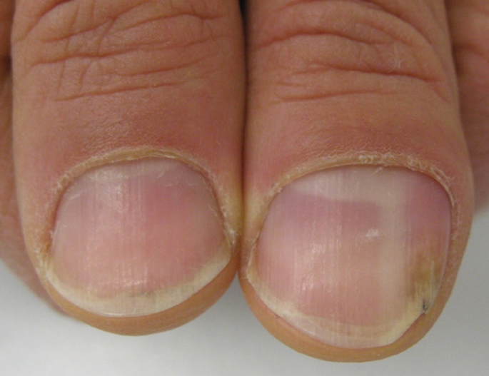 I have Beau's line (a horizontal groove/ridge line) only on my big toenails.  What causes this? - Quora