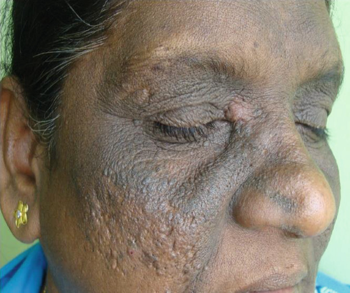 melanotic hyperpigmentation Melaninassociated pigmented lesions of the oral mucosa: presentation, differential diagnosis, and treatment - Mller - 2010 - Dermatologic Therapy Gingival Pigmentation Removal With a