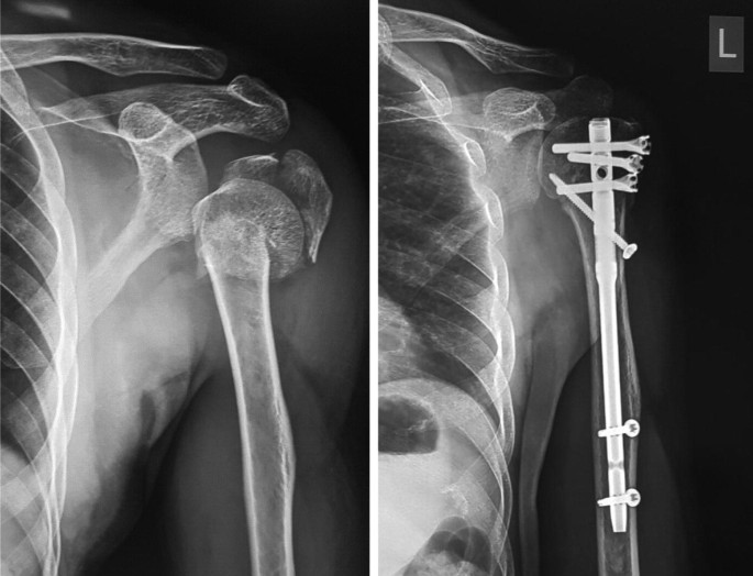 The portal of Neviaser: a valid option for antegrade nailing of humerus  fractures | Journal of Experimental Orthopaedics | Full Text