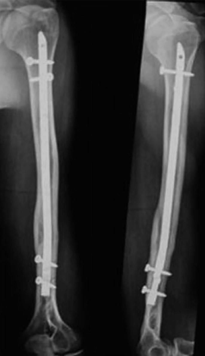 Two-part varus fracture. K-wires employed as a joystick to... | Download  Scientific Diagram