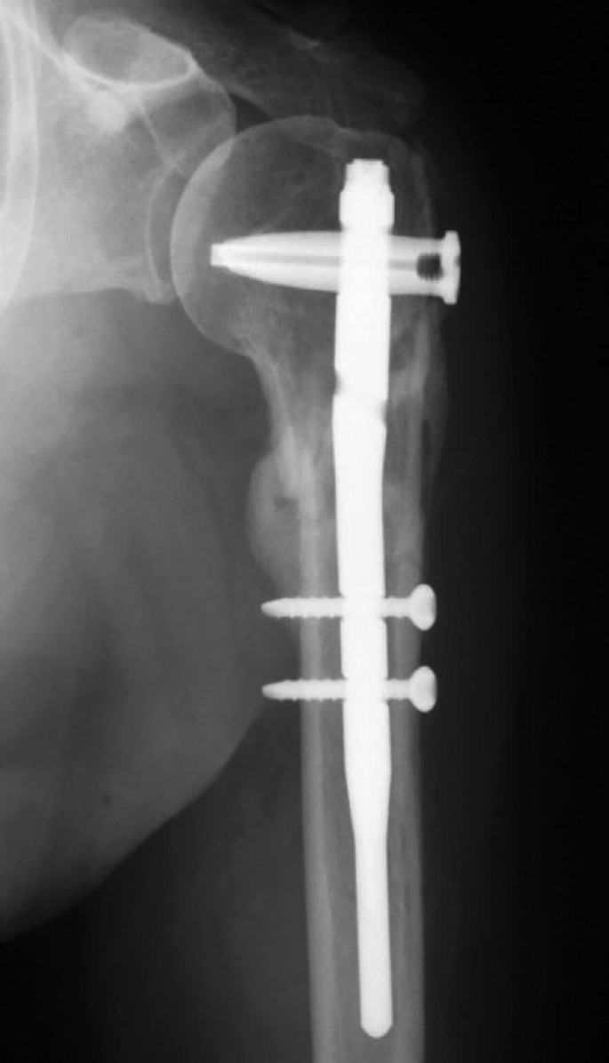 Intramedullary nailing for pathological fractures of the proximal humerus  caused by multiple myeloma: A case report and review of literature