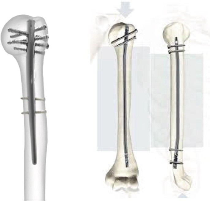 Evolution of Intramedullary Nails in Long Bones of the Upper Limb |  SpringerLink