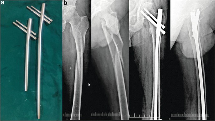 Proximal Femoral Long Nail Pfna Nail Proximal Nail Canwell - China Medical  Supply, Orthopedic Implant | Made-in-China.com