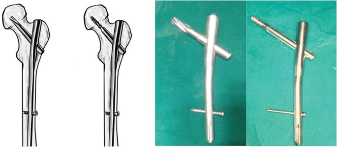 Type 6 femoral deformity in a 28-year-old woman after Enders nailing.... |  Download Scientific Diagram