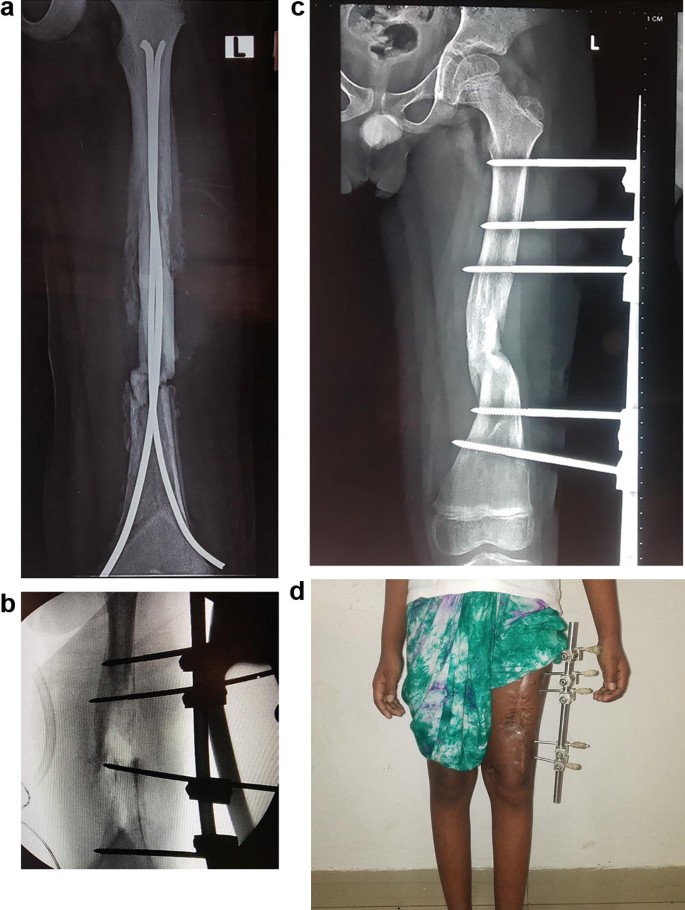 Ring external fixator (definitive) for Complete articular fracture,  fragmentary articular