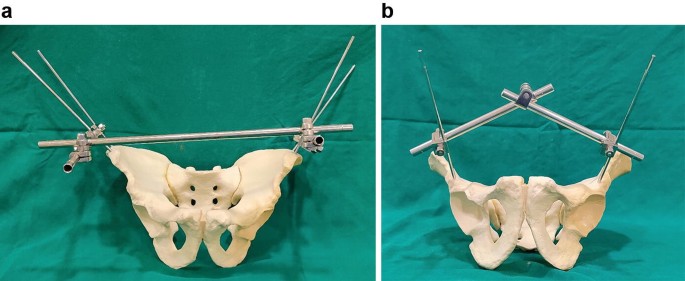 Ring external fixator (definitive) for Complete articular fracture,  fragmentary articular