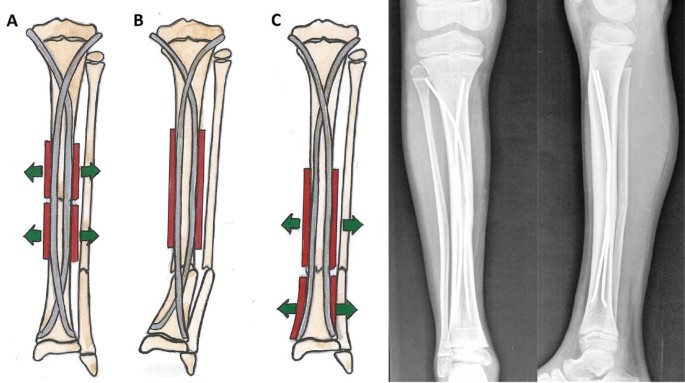 Focus on interlocking intramedullary nailing without fluoroscopy in  resource-limited settings: strategies, outcomes, and outlook |  International Orthopaedics