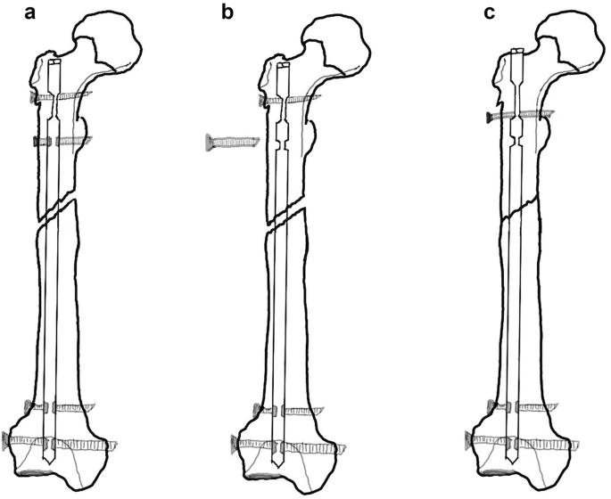 Antegrade and Retrograde Femoral Nailing | SpringerLink
